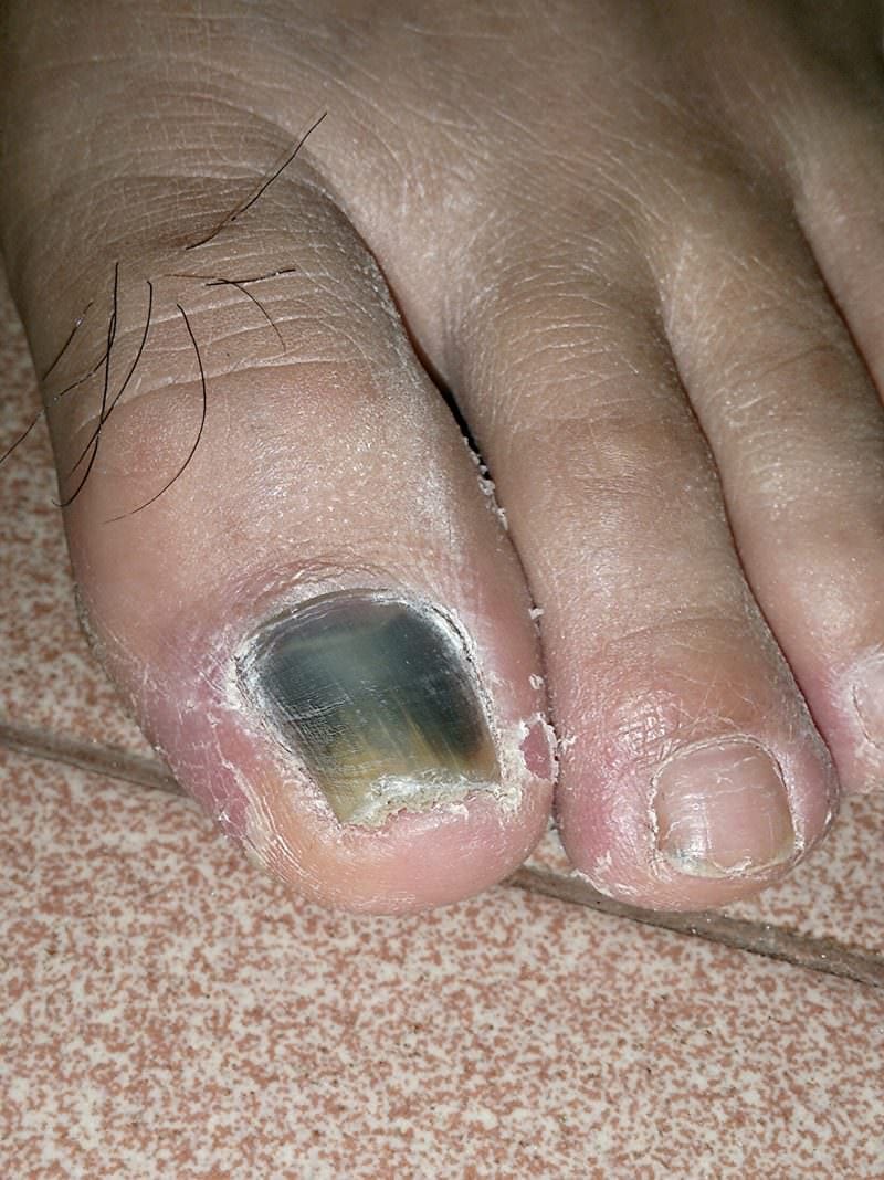 What Is Black Toenail And How To Treat It Marietta Foot Doctor