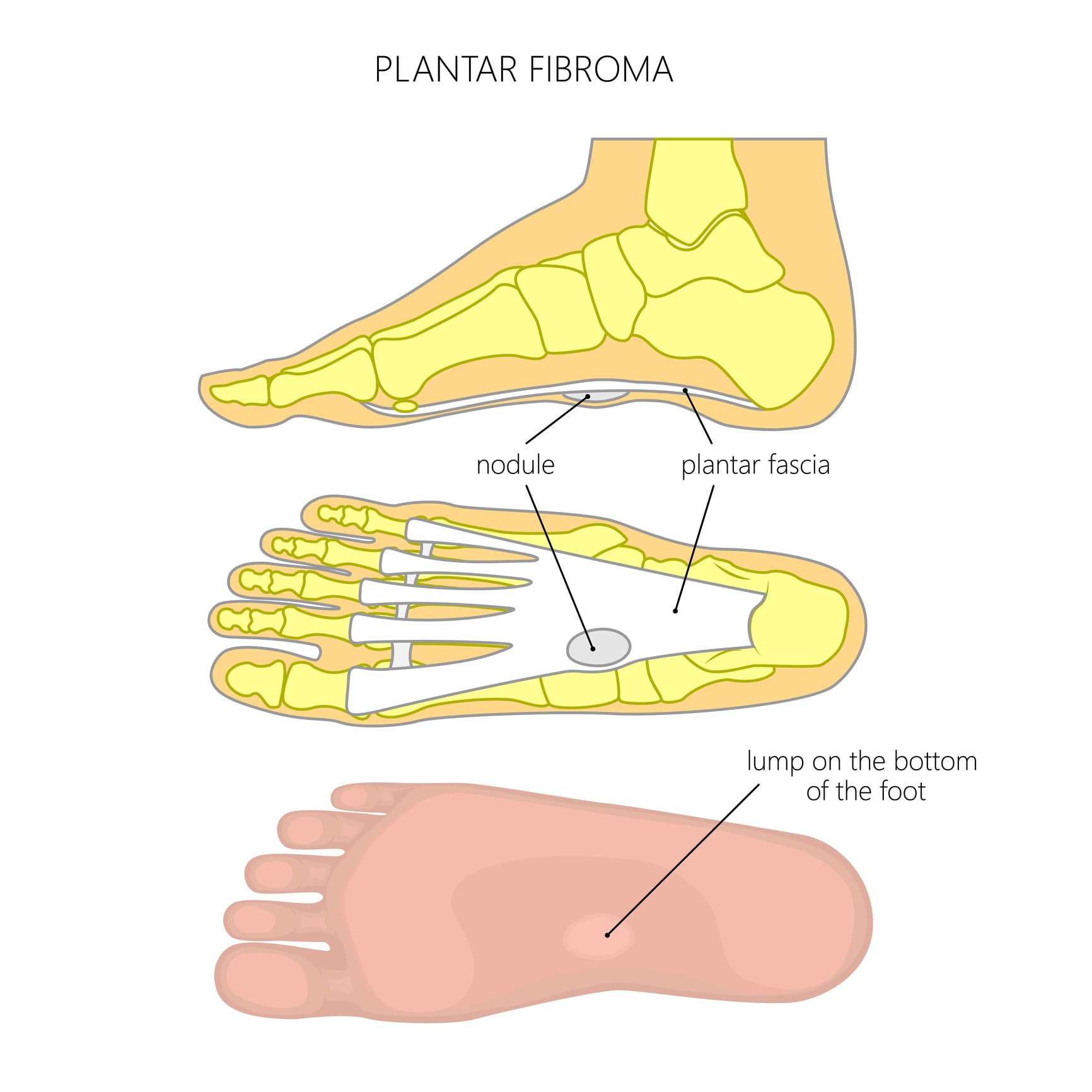 Plantar Fibroma Removal Surgery