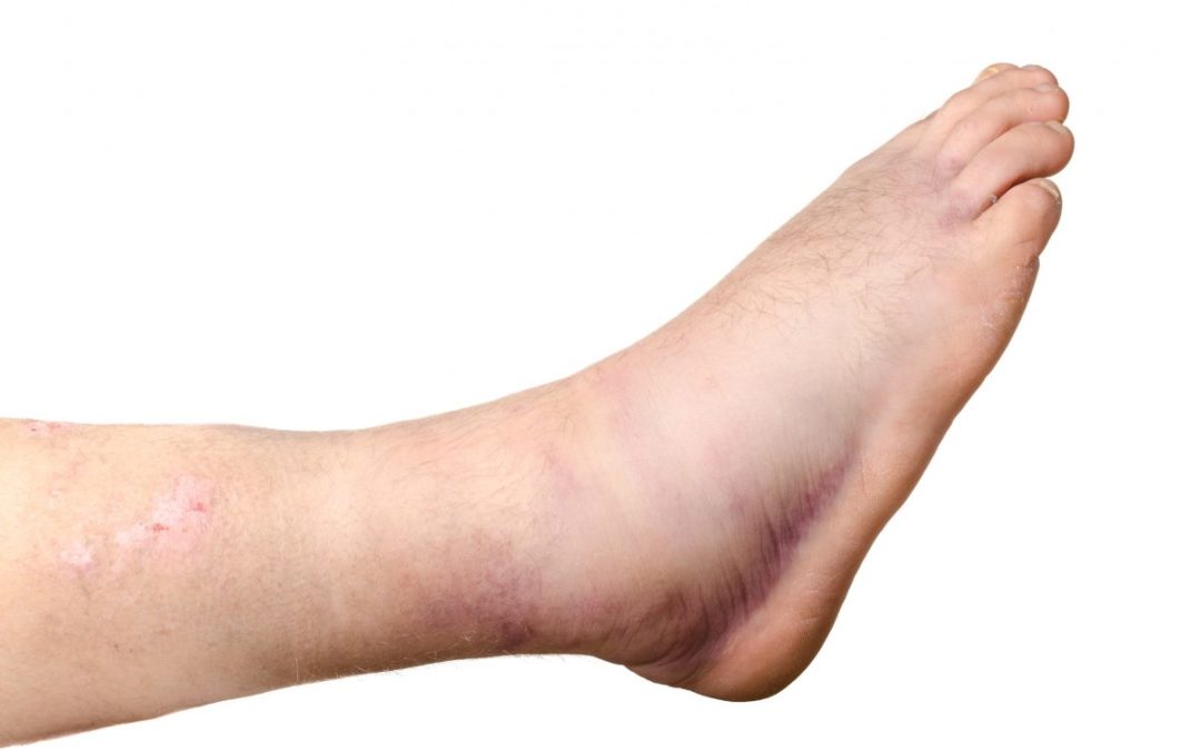 What Are the Symptoms of a Broken Ankle?