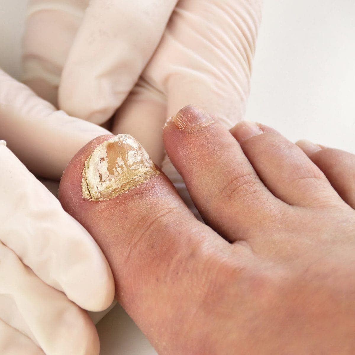 What Is White Toenail And How To Fix Them! | Marietta Foot Doctor
