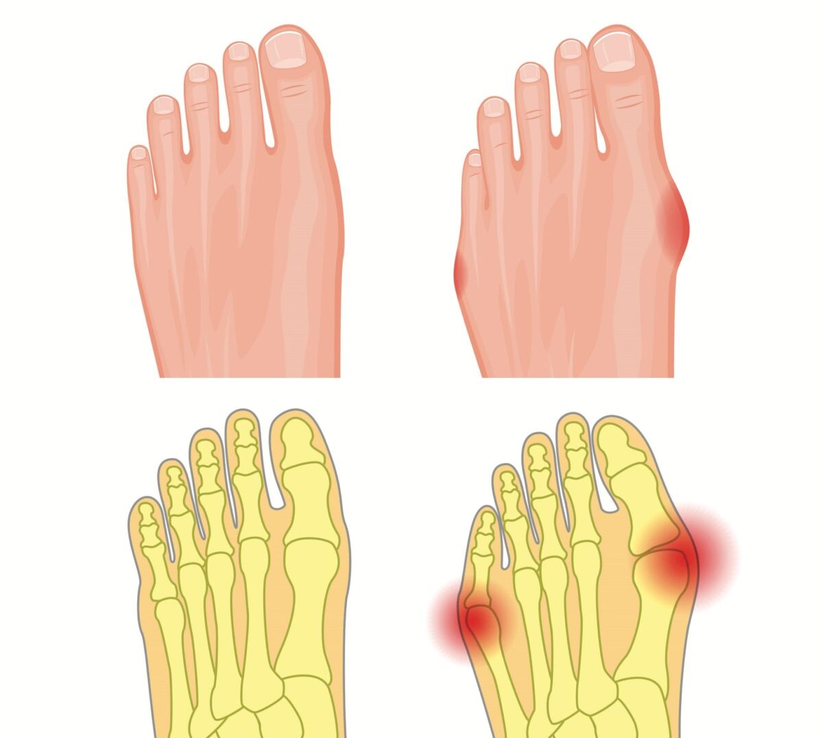 Hammer Toe Correction via Arthroplasty